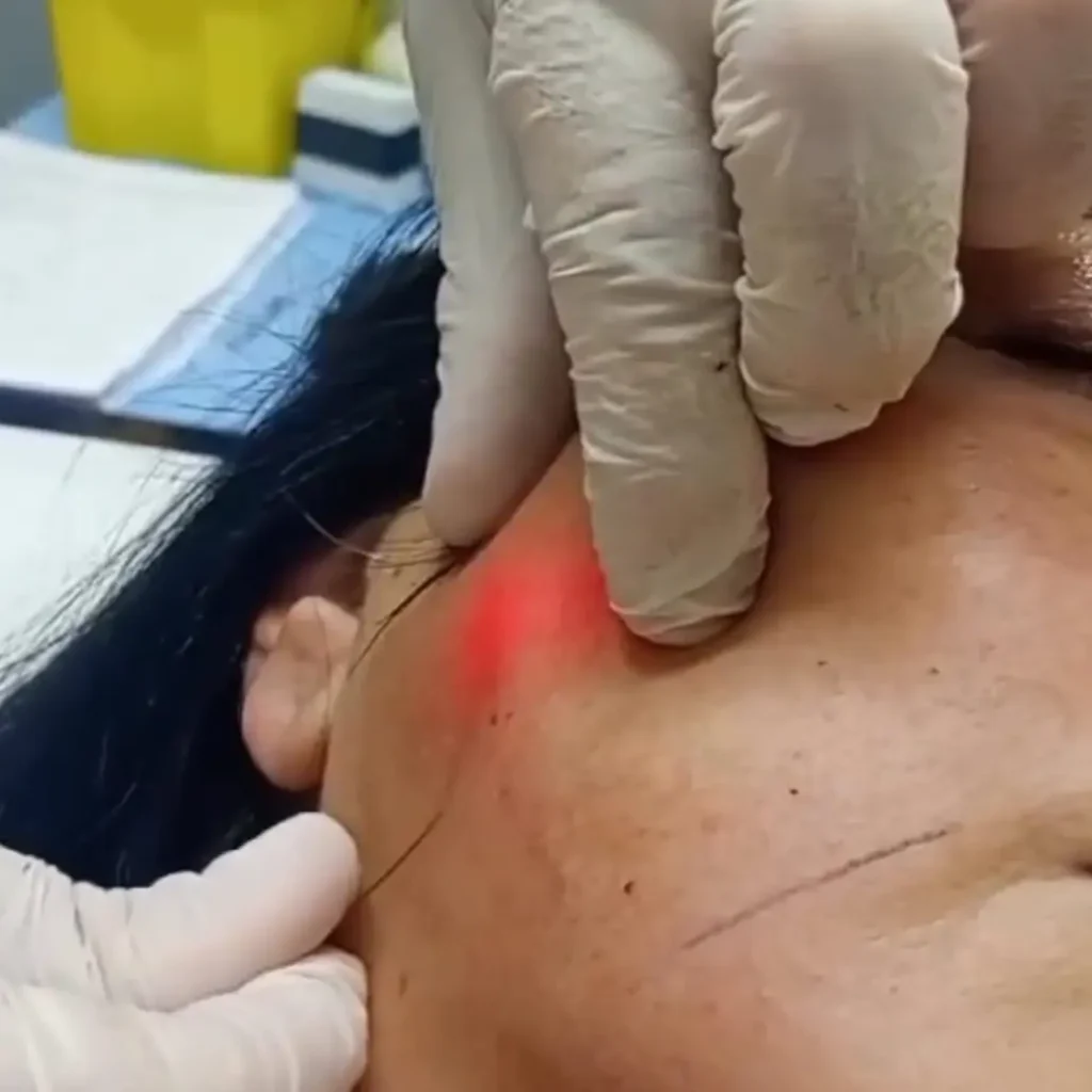 Endolift laser