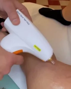 LASER VASCOLARE