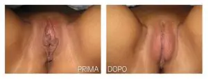 labioplastica